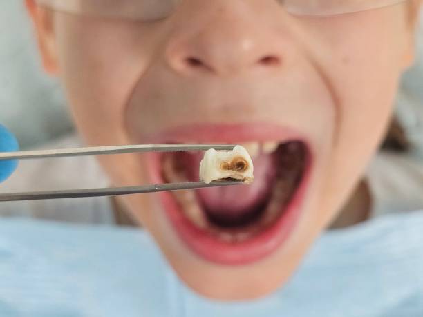 Best Emergency Tooth Extraction in Perkasie, PA